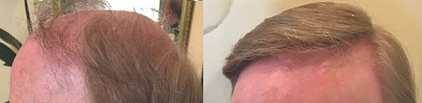 hair replacement for men wayland ma