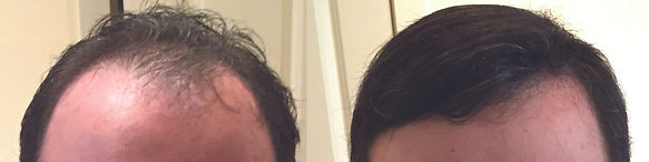 men's hair replacement systems pepperell