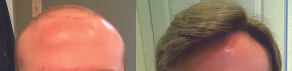 wilmington hair replacement