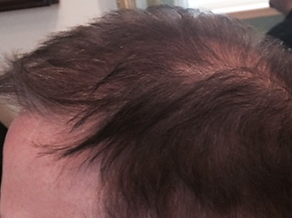 before hair replacement systems for men
