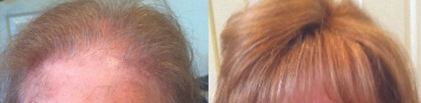 hair replacement for women gloucester ma