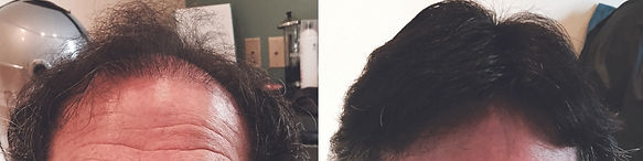 men's hair replacement upton