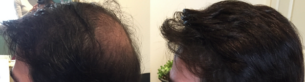 hair replacement for men buckland ma