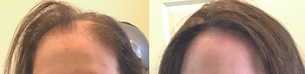 hair replacement for women brimfield ma
