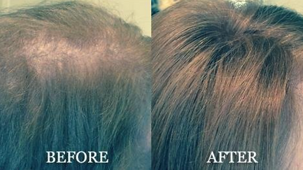 hair replacement for women hampshire ma