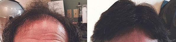 hair replacement for men cummington ma