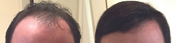 hair replacement for men near ashby ma