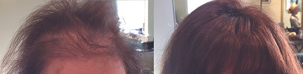 wilmington hair replacement