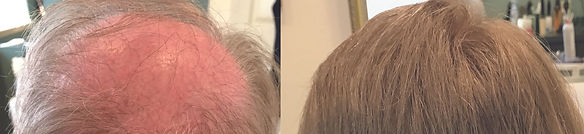 hair replacement wellesley ma