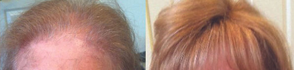 hair replacement for women cummington ma