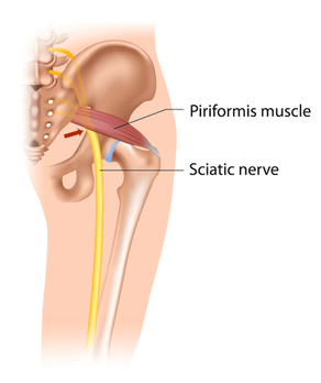Three Reasons for Sciatica (and how to treat it)