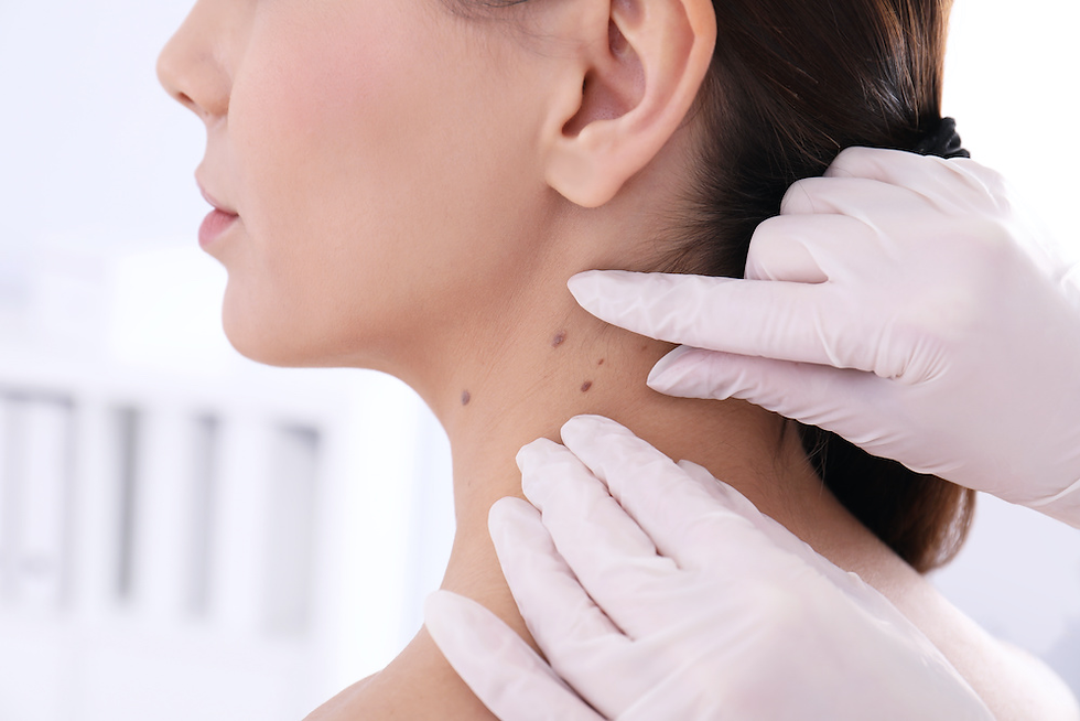 The Different Types of Mole Removal Available in Dubai
