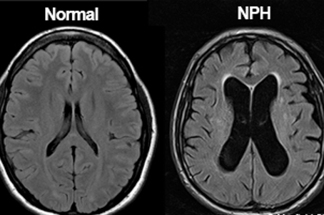 NPH: Wet, Wacky, and Wobbly!