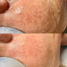 Hos oss an du effektivt och säkert behandla missprydande solskador, åldersfläckar och andra typer av pigmenteringar. Lasern används också för att reducera ytliga blodkärl, rosacea och diffus hudrodnad.