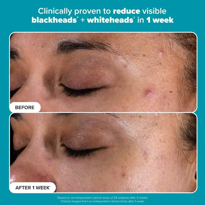 Thumbnail: Paula's Choice  Skin Perfecting 2% BHA Exfoliating Toner for Clear Skin