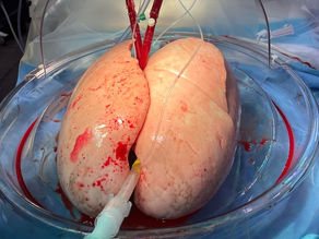 Four lungs successfully evaluated and transplanted