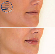 LIP FILLER SECOND_.jpg