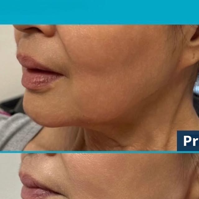 Filler Labbra con Radiesse: risultati