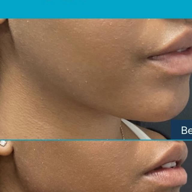 Filler Labbra: definizione naturale