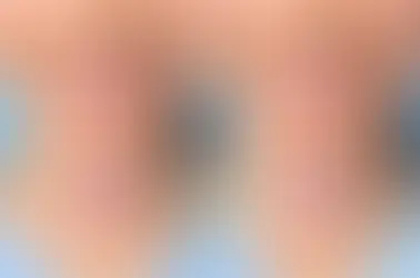 Diastema tratado antes y después del tratamiento