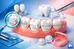 Guía de brackets estéticos para elegir bien