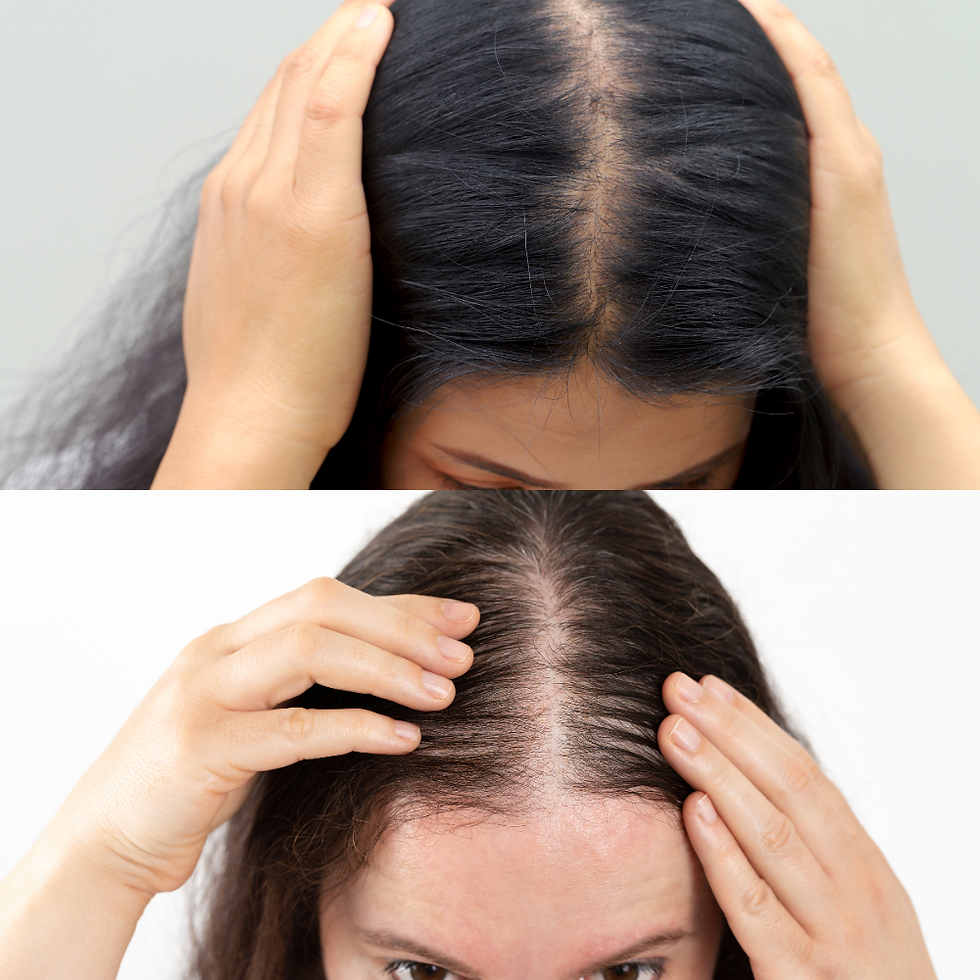 Thưa tóc vùng đỉnh luôn là lí do khiến phụ nữ tự ti