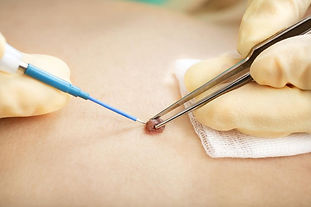Cirurgia dermatológica