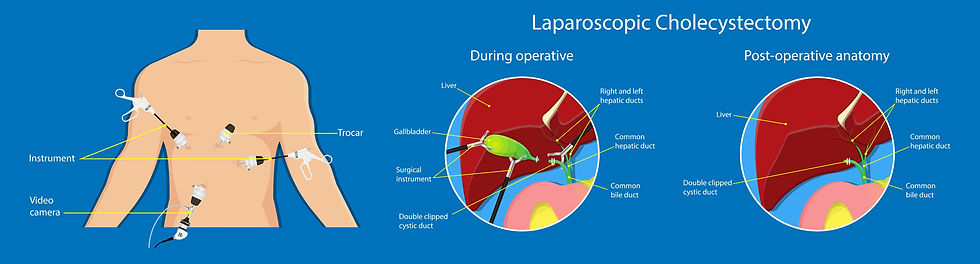 Gallbladder Removal