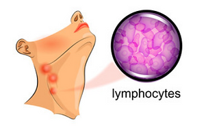 can semaglutide cause swollen lymph nodes Enlarged Lymph Node