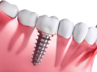 dental-implants.jpg