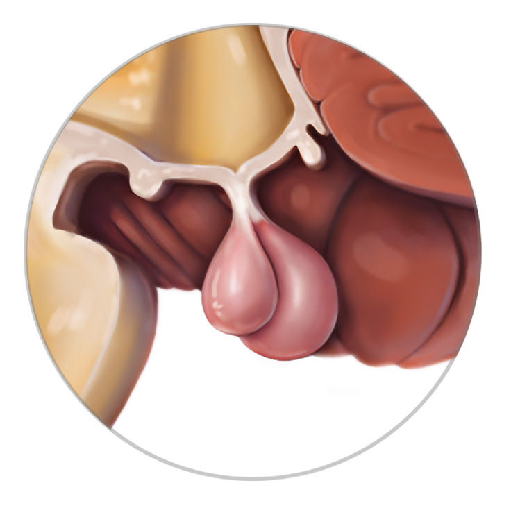Medical illustration of male pelvic anatomy highlighting the prostate gland with labeled relationships to bladder, urethra, and reproductive structures.
