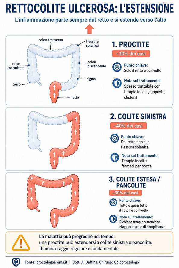 Infografica con tre diagrammi schematici del colon disposti verticalmente che illustrano le tre forme di estensione della Rettocolite Ulcerosa: proctite (solo retto coinvolto, circa 30% dei casi), colite sinistra (dal retto alla flessura splenica, circa 40% dei casi) e colite estesa o pancolite (tutto il colon, circa 30% dei casi). Le aree infiammate sono evidenziate in colore corallo, con frecce che indicano la direzione di progressione dal retto verso l'alto.