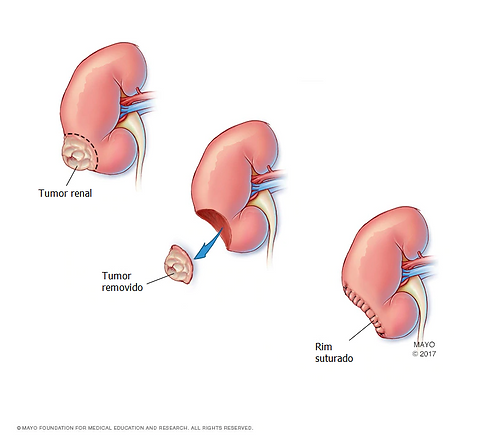 NEFRECTOMIA PARCIAL