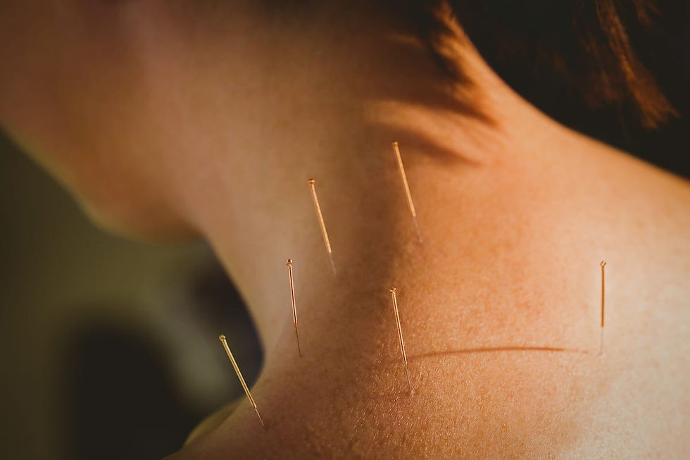 Eye-level view of acupuncture needles placed on a patient's back