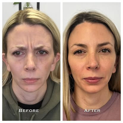 before and afters of Evercare client who had their 11 lines removed