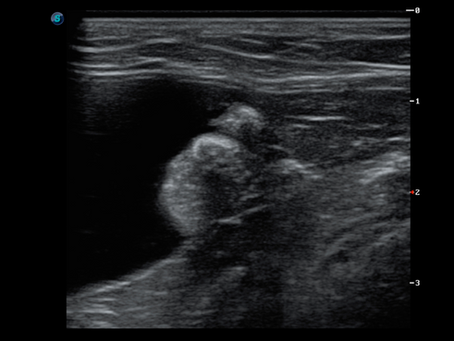 Urinary bladder transitional cell carcinoma (TCC) in a male cat.