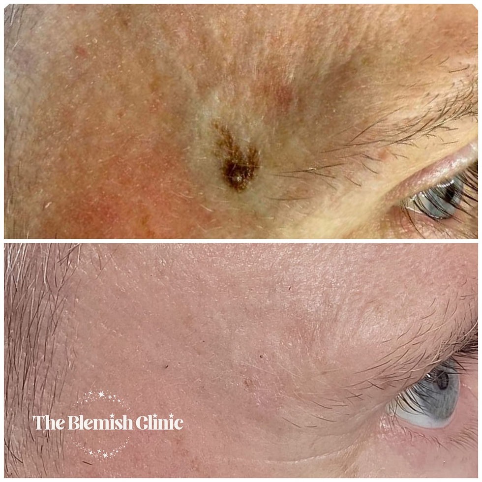 sun-spot-before-and-after