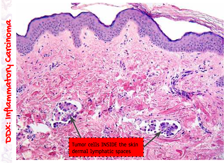High Yield Breast Pathology Acute Mastitis/Breast Abscess