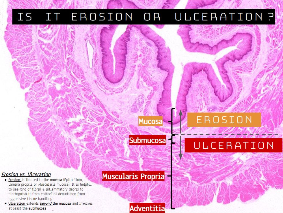 Esophageal Erosion vs. Ulceration? How can you tell a difference
