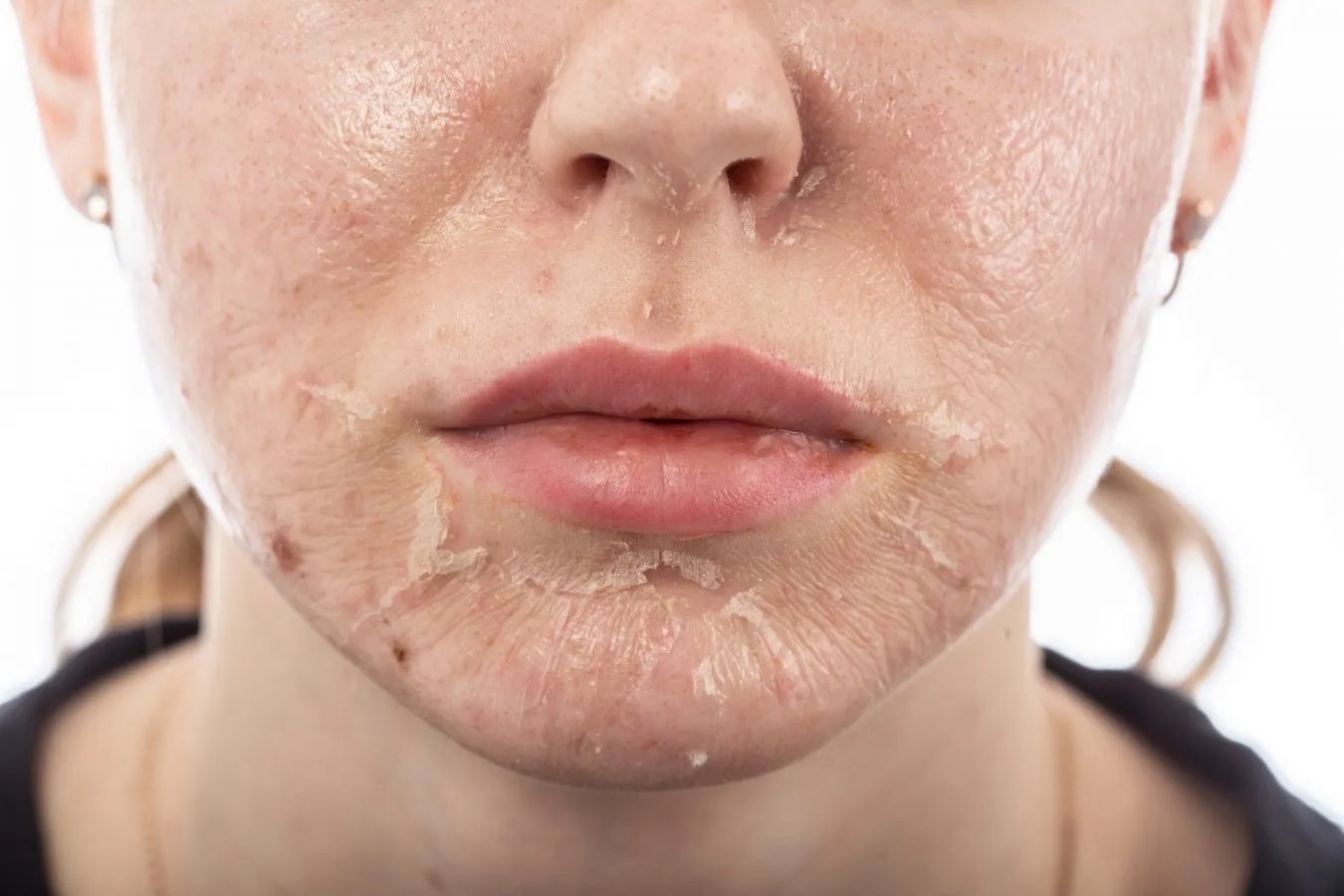 Peeling-skin.webp