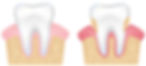 Healthy Gums - Periodontitis.jpeg