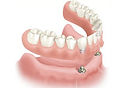 Overdenture.jpeg