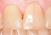 RCT - Fractured Tooth.jpeg