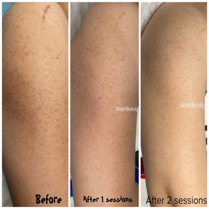 Before and after photos showing skin improvement with AileenBeauty treatments