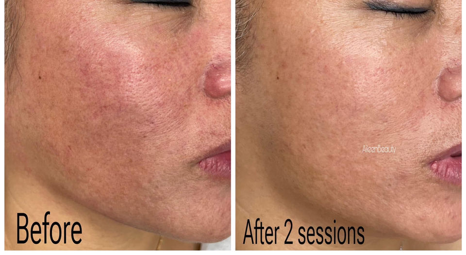 Before and after 2 sessions of skin treatment, showing improvement in skin texture and tone.