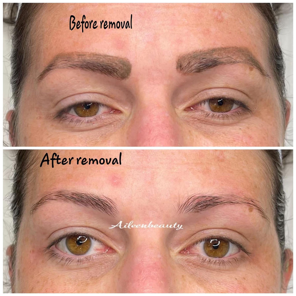 Before and after eyebrow removal, showing brows before and after with text "Before removal" and "After removal" along with the Aileenbeauty logo.