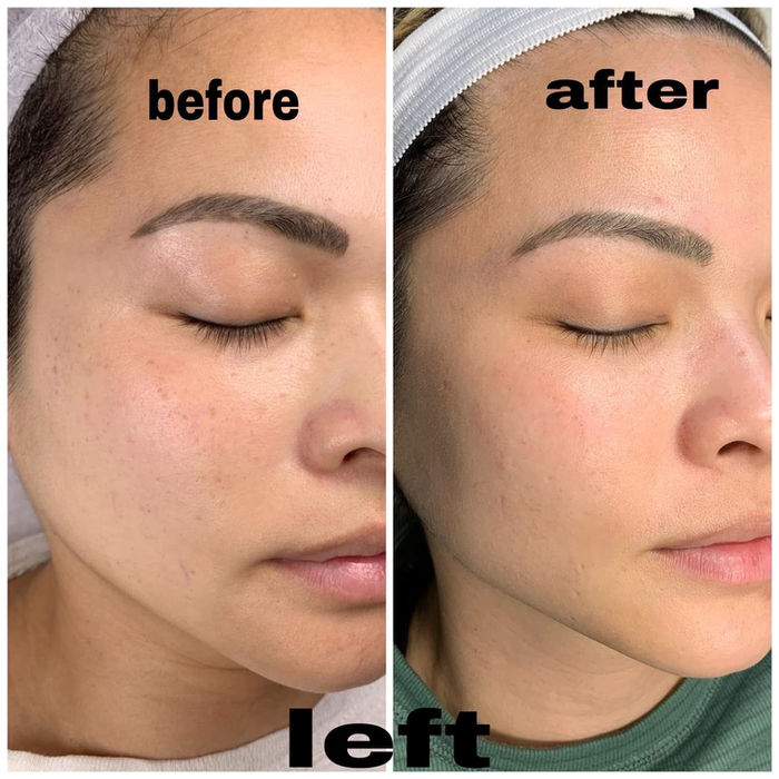 Before and after photos showing skin improvement, labeled 'before' and 'after' with the word 'left' below.