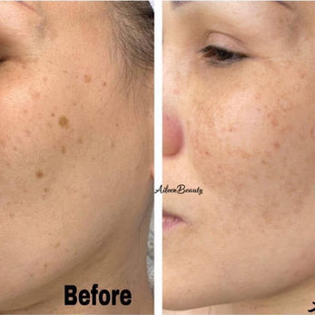 Side-by-side comparison of skin before and after treatment, with text 'Before' and 'After'