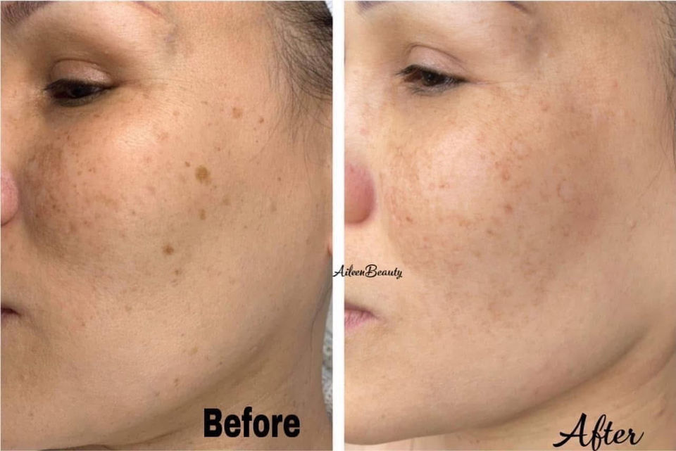 Skin before and after treatment, showing reduced hyperpigmentation, Before and After, Aileen's Beauty