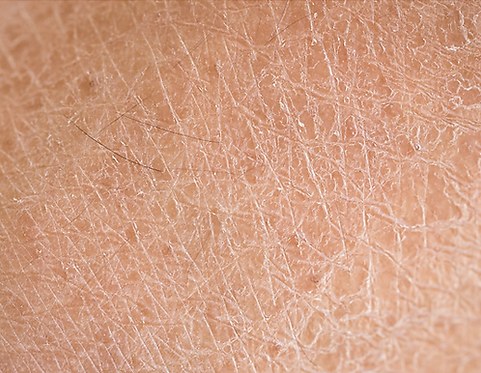 dry skin